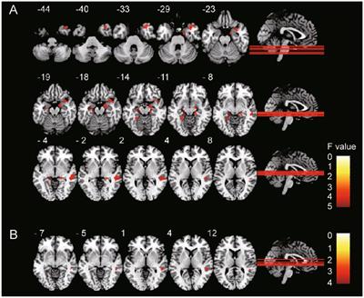 Voxel-based morphometry reveals the correlation between gray matter volume and serum P-tau-181 in type 2 diabetes mellitus patients with different HbA1c levels